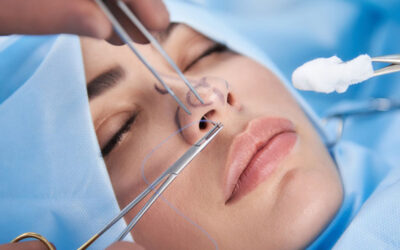 Conoce las diferencias entre una rinoplastía abierta y cerrada