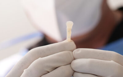 ¿Para qué sirve la colocación o el injerto de cartílago en la nariz?