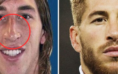 Futbolistas que se han realizado una rinoplastía