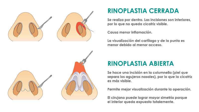 Diferencias entre rinoplastía abierta y cerrada