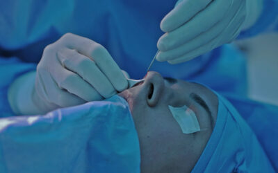 ¿Cuándo me puedo hacer una rinoplastía secundaria  o  retoque?