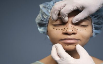 ¿Cuál es la edad para realizarse a una rinoplastía?