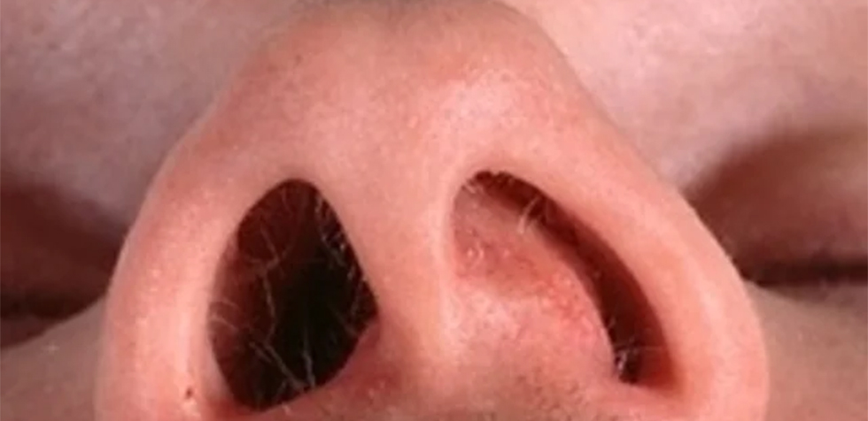 Fosas nasales asimétricas