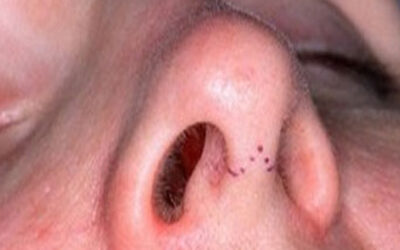 La rinoplastía deja cicatrices