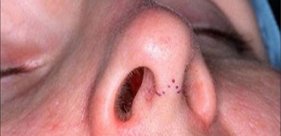 La rinoplastía deja cicatrices