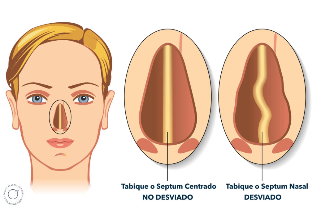 Desviación de tabique 