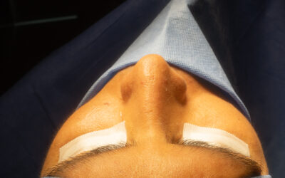 Rinoplastia funcional