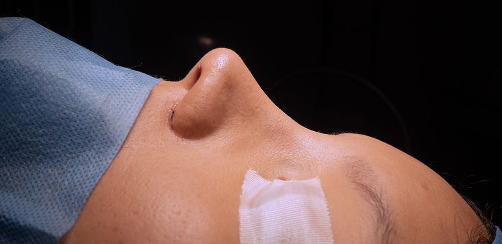 septoplastia en lima