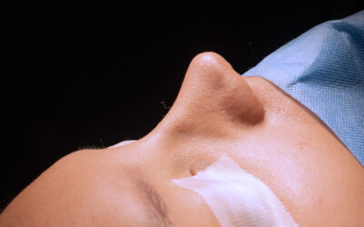 Rinoplastia funcional: mejora tu respiración y tu calidad de vida