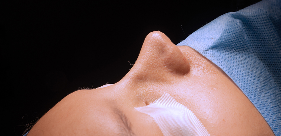rinoplastia funcional