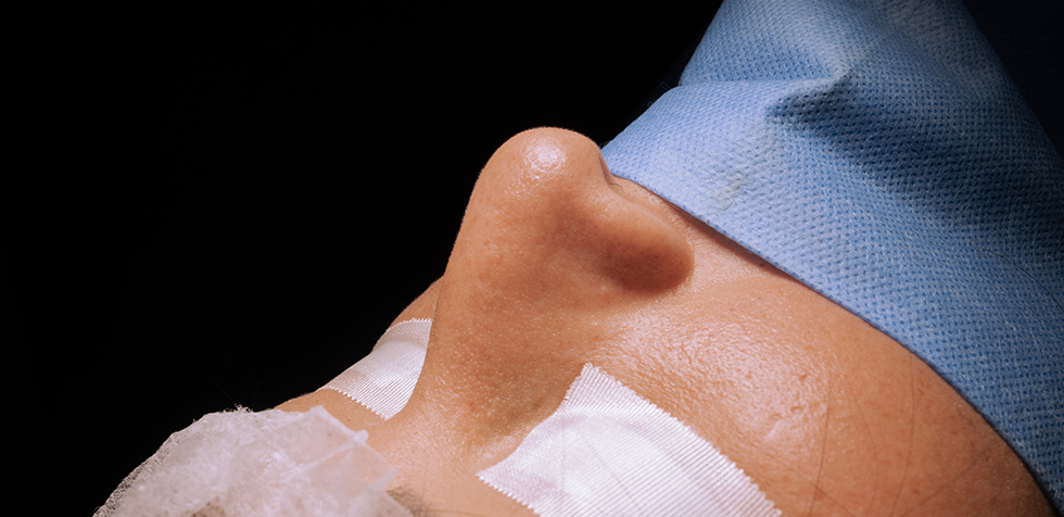 rinoplastia con el dr guanilo