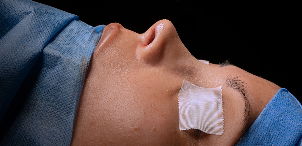 Rinoplastia ultrasónica en Perú