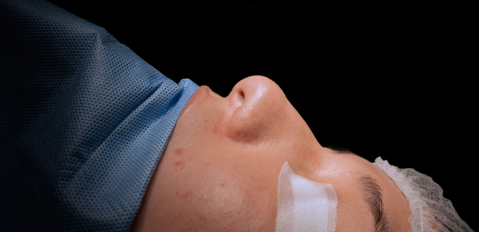 rinoplastia