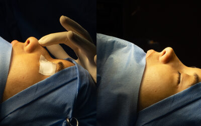 Rinoplastia ultrasónica en Lima
