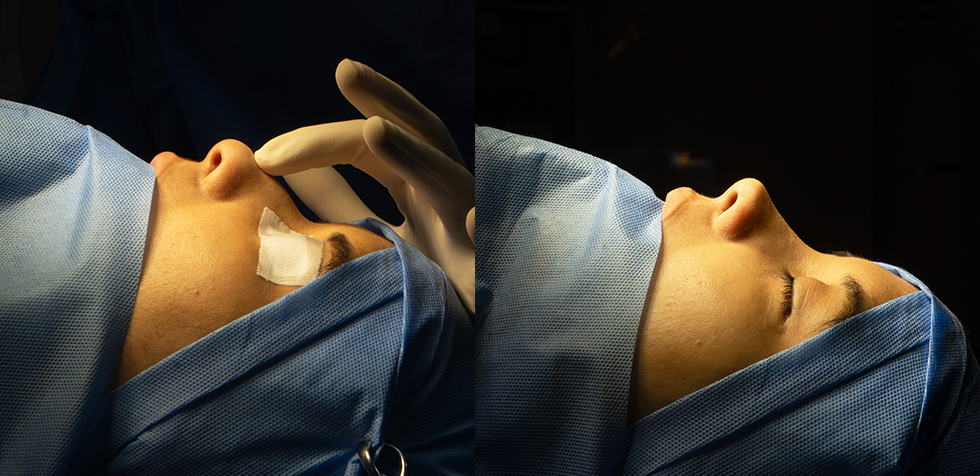 Rinoplastia ultrasónica en Lima