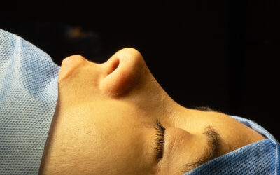 Rinoplastia Ultrasónica