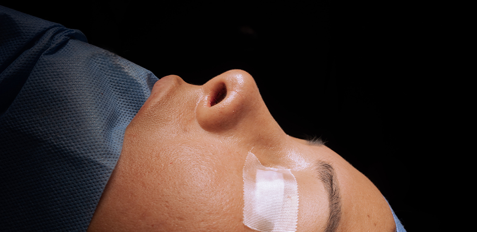 rinoplastia lima