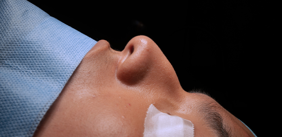 rinoplastia en peru