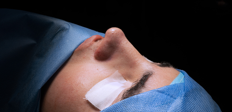 rinoplastia peru