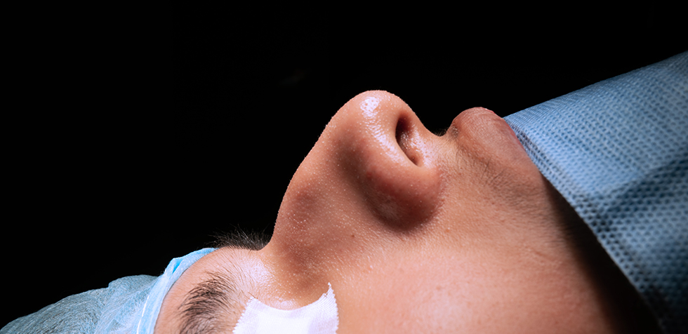 rinoplastia en lima