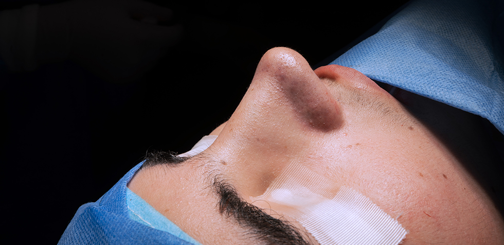 rinoplastia peru