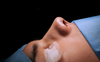 Rinoplastia Ultrasonica en Lima: Precio y Resultados con el Dr. Guanilo