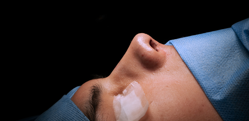rinoplastia ultrasonica