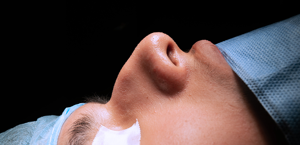 rinoplastia en el perú
