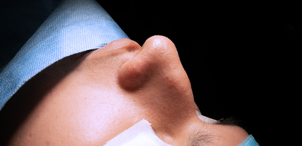 septoplastia