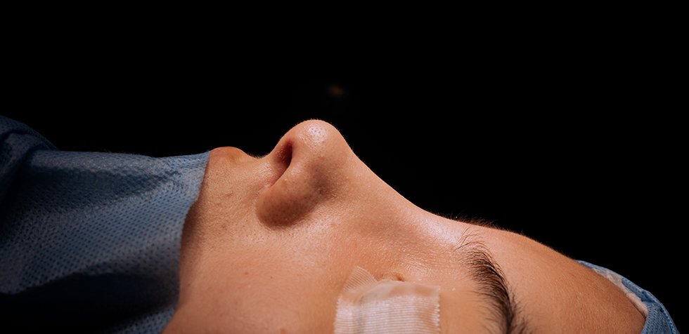 rinoplastia funcional