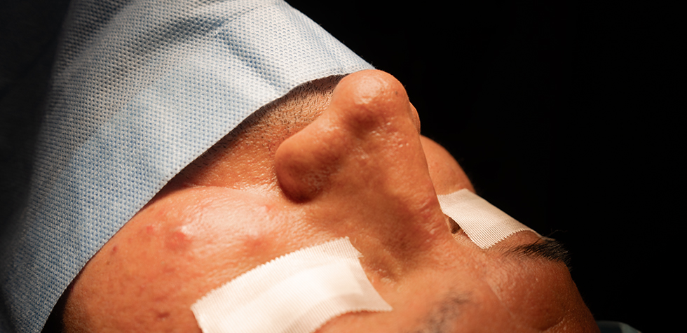 clinica de rinoplastia