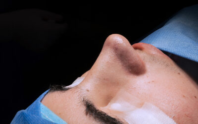 Especialista en rinoplastia: Dr. Guanilo y su técnica avanzada con ultrasonido y láser