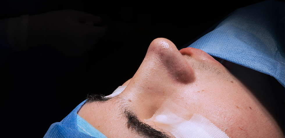 Especialista en rinoplastia: Dr. Guanilo y su técnica avanzada con ultrasonido y láser