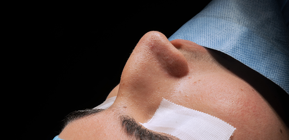 rinoplastia ultrasonica