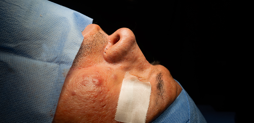 rinoplastia en piel gruesa