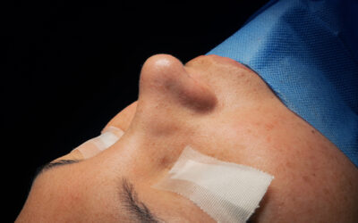 Diferencia entre rinoplastia y septoplastia
