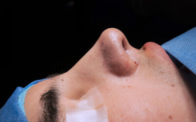 Rinoseptoplastia en Lima: equilibrio entre función y estética nasal