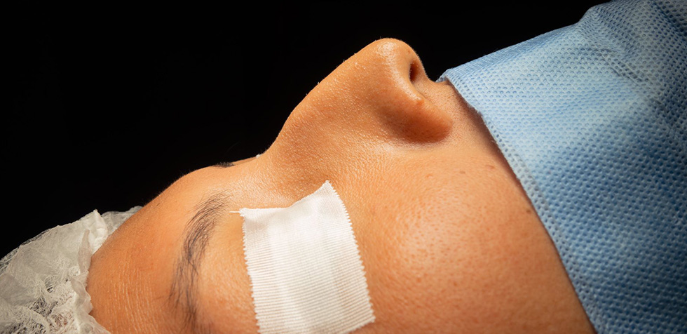 rinoplastia en varones