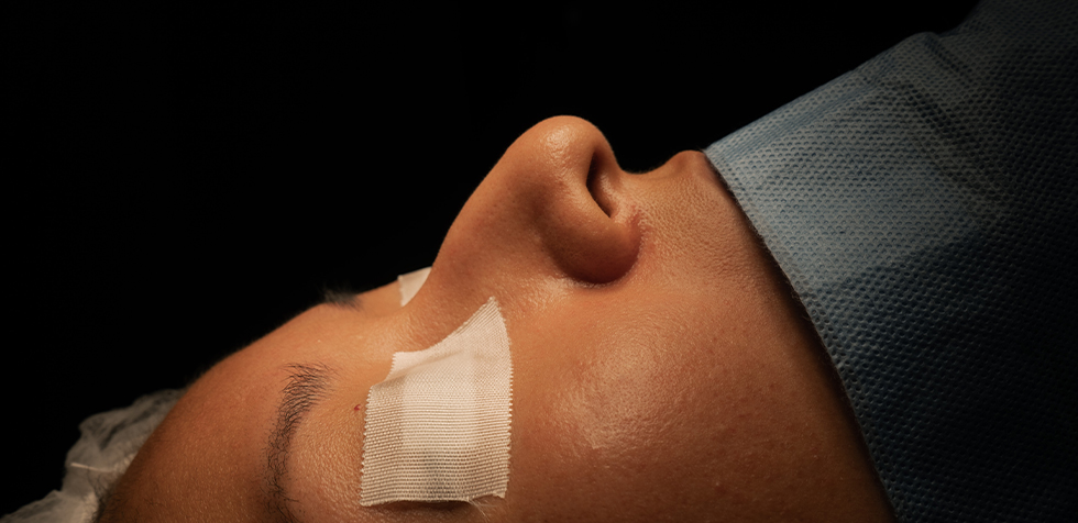 que comer despues de una rinoplastia