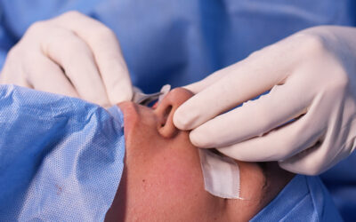 Cartílago costal en rinoplastia