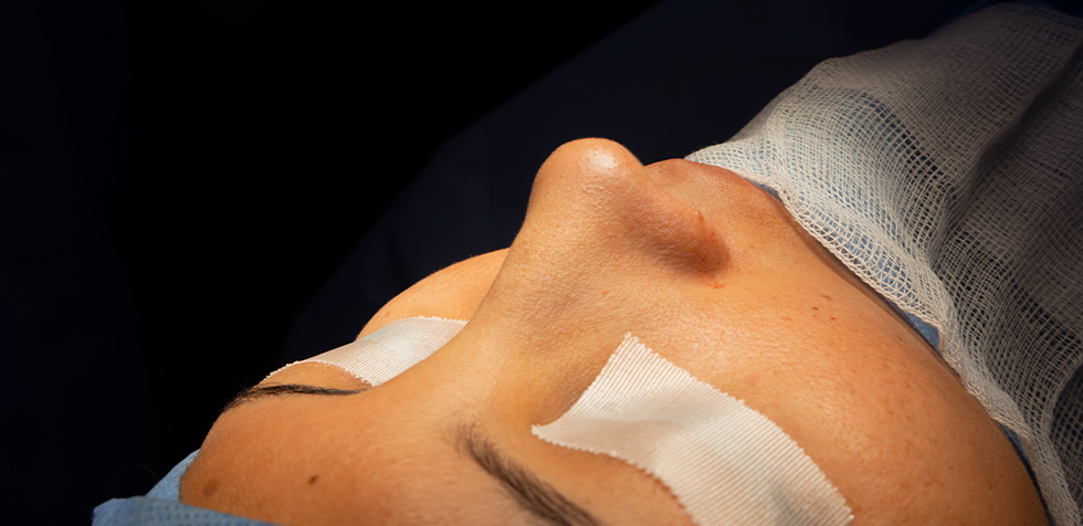 rinoplastia ultrasonica