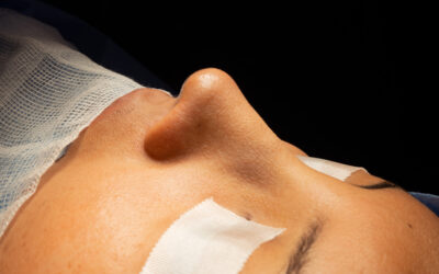 Piel delgada en rinoplastia