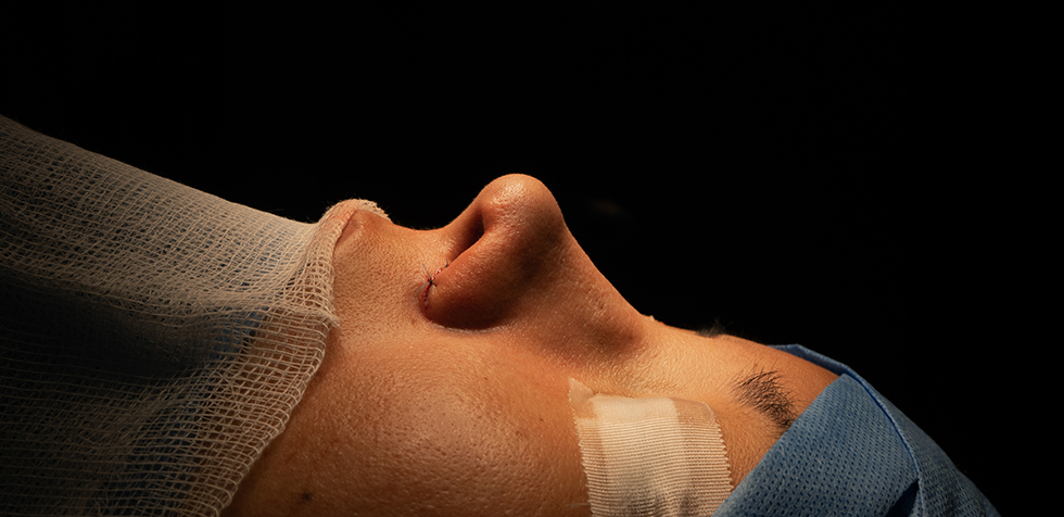 ¿Cuánto cuesta la rinoplastia en el Perú?