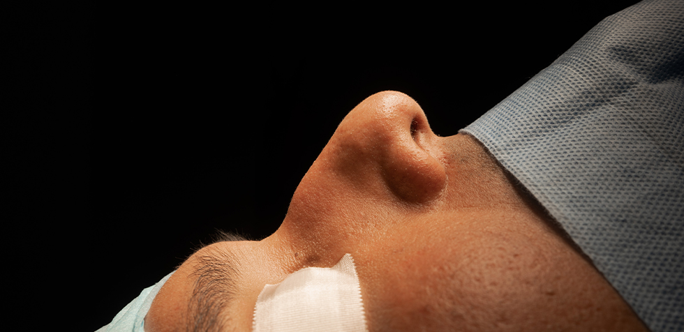 rinoplastia ultrasonica lima