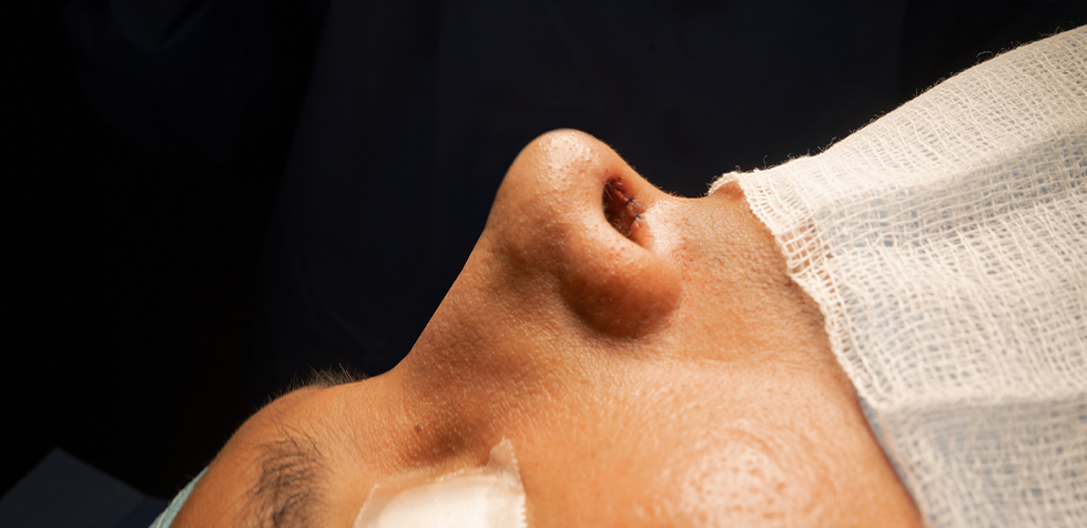 rinoplastia ultrasonica precio