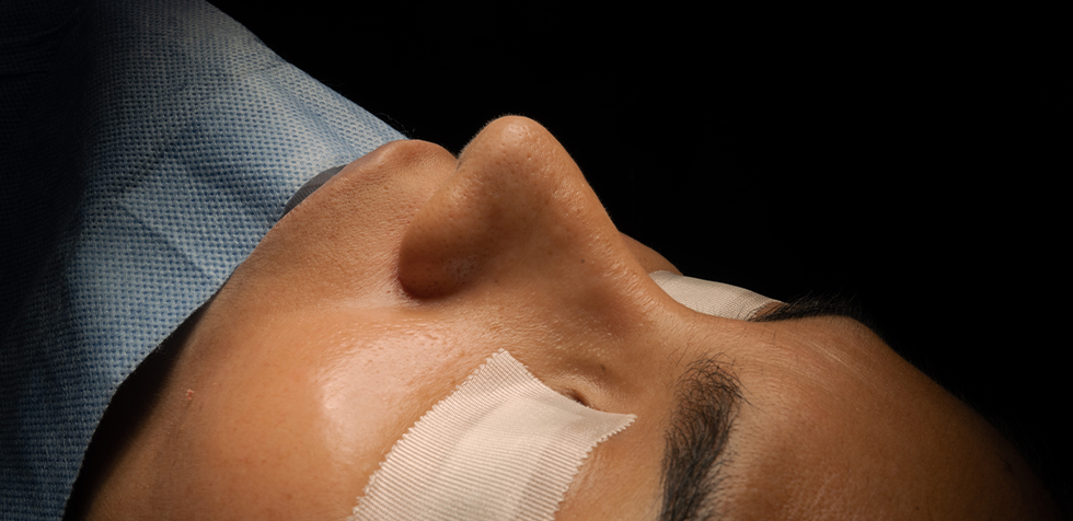 cuidados de la piel después de una rinoplastía