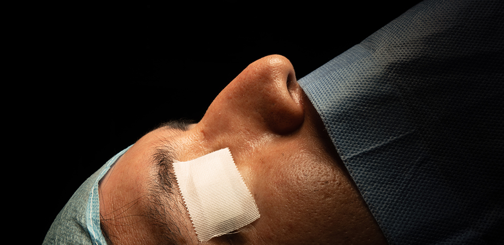 rinoplastia ultrasonica laser