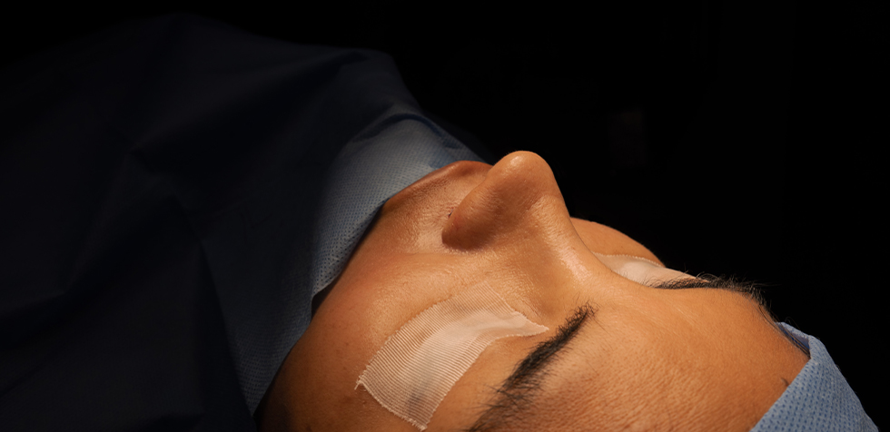 rinoplastia mitos rinoplastia precio peru