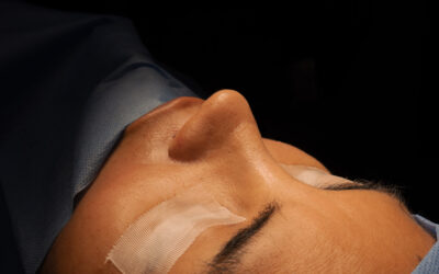 Cuidados de la piel tras una rinoplastia