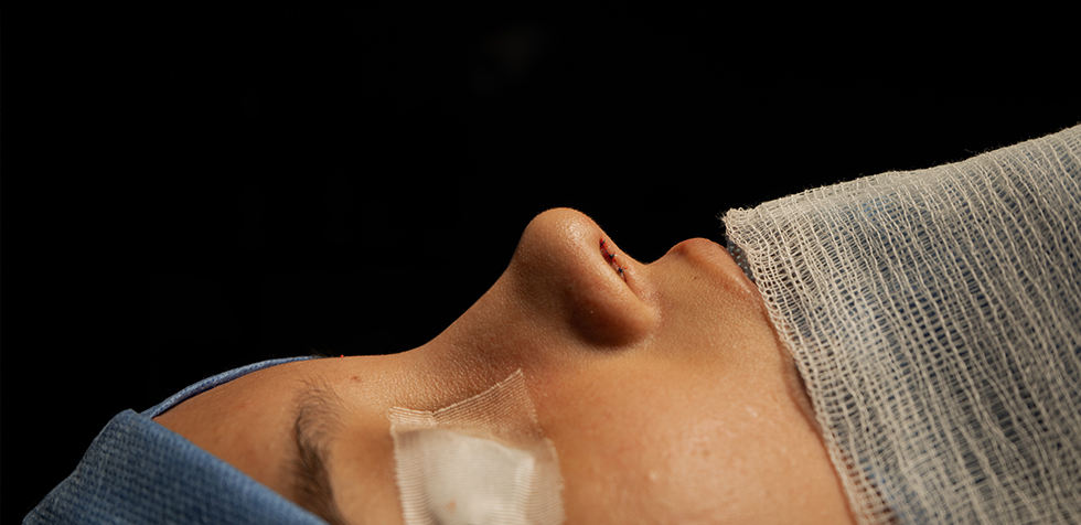 cicatrizacion rinoplastía como acelerar la cicatrización en una rinoplastía